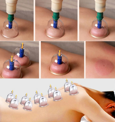 Vacuum Cupping Device